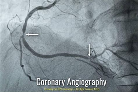 Coronary Angiogram Procedure in the Philippines .
